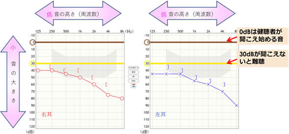 音のきこえの測定