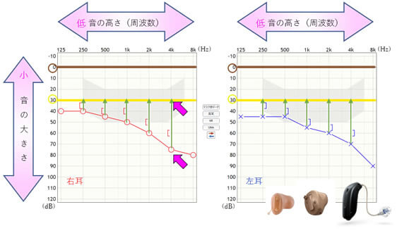 補聴器で聞こえを改善する